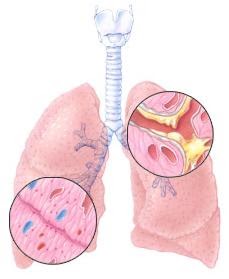como sacar la flema de los pulmones a un bebe